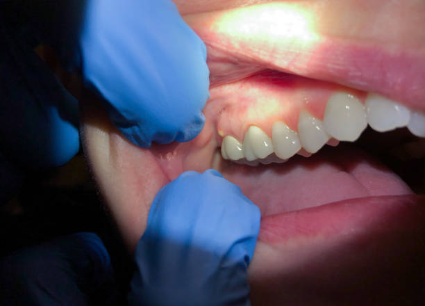 Best Dental Abscess Treatment in Tamiami, FL
